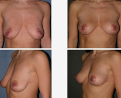 breast lift without implants