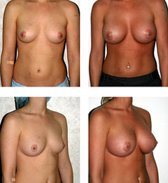 breast augmentation with silicon
