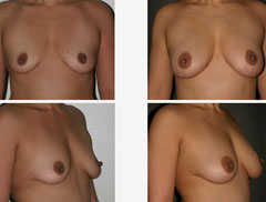 breast augmentation with fat injections