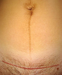 cesarean section risks