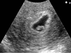 embryo at 6 weeks pregnant
