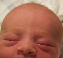 eyelid edema puffy eyes newborn