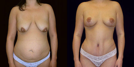 mommy makeover before and after