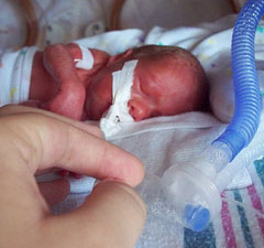 Premature Babies Survival Rate Statistics
