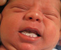 severe thrush in babies