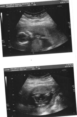 Ultrasound Picture Of My Boy
