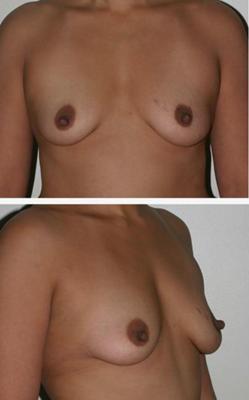 Inflated Breasts After Pregnancy