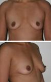 Inflated Breasts After Pregnancy