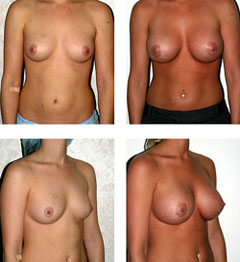 Breast Augmentation with silicon