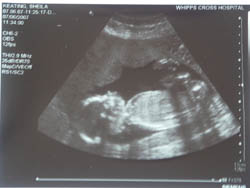 21 weeks pregnant ultra scan