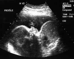 28 weeks ultrasound