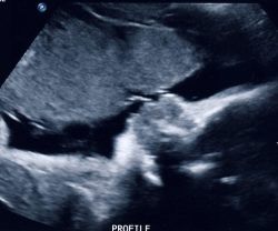 31 weeks ultrasound
