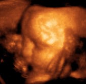 3d ultrasound 29 week