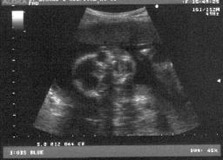fetal ultrasound scan at 23 weeks