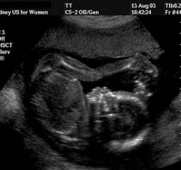 18 weeks pregnant ultrasound
