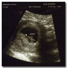 7 weeks pregnant ultrasound