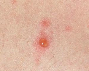 chickenpox blister