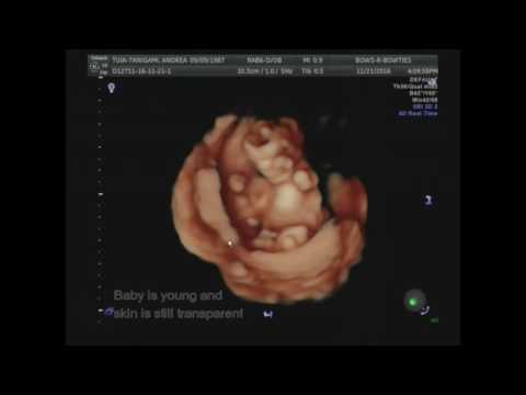 13 week 3D and HD 3D and 4D ultrasound