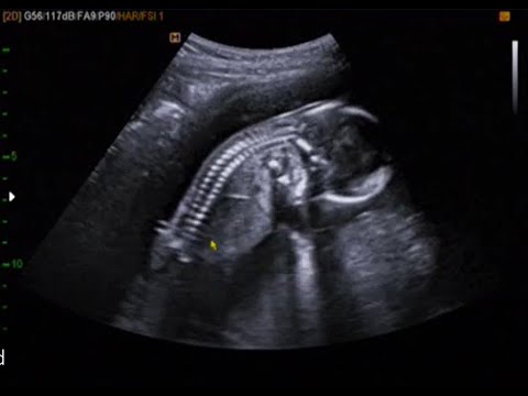 fetal ultrasound of 16 weeks 17 weeks baby boy moving