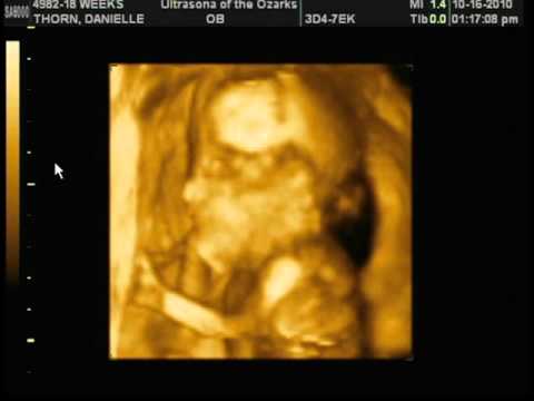 Boy or Girl? 4D Ultrasound 18 Weeks Gender Determination