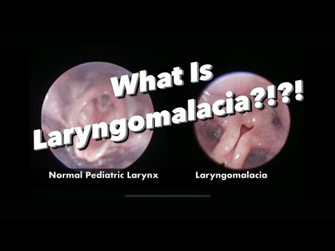 Laryngomalacia - What is it, what are the symptoms, how is it managed