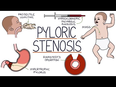 Understanding Pyloric Stenosis