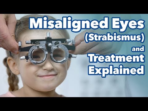 Misaligned Eyes (Strabismus) and Treatment Explained. What is Strabismus?