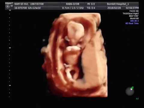 fetal ultrasound of 12 weeks baby boy moving (3D)