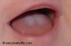 Baby Thrush Symptoms