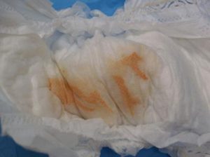 Urate Crystals In Newborn Diaper gives orange pee color
