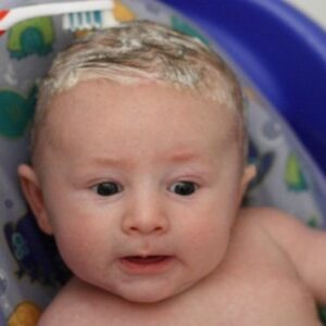 How To Cure Cradle Cap And Eczema In Babies?