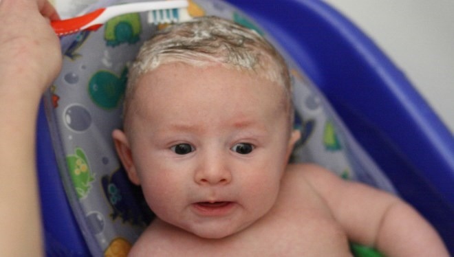 cradle cap and eczema in babies