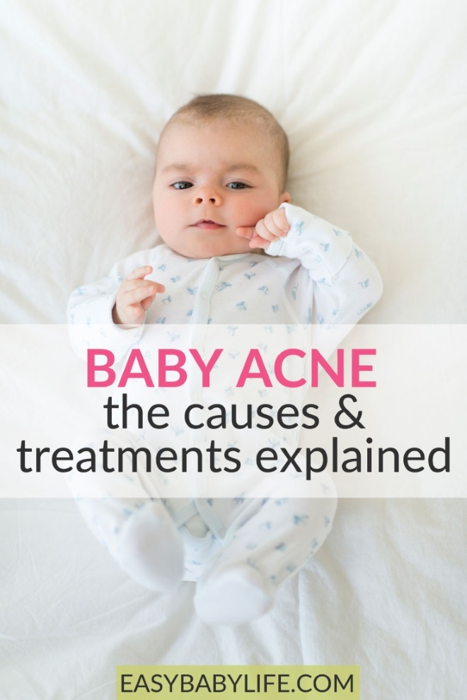 Baby Acne 101 The Causes And Treatments Explained New Baby Qanda