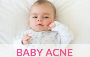 Read more about the article Baby Acne 101 – The Causes And Treatments Explained