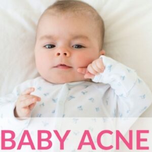 Baby Acne 101 – The Causes And Treatments Explained