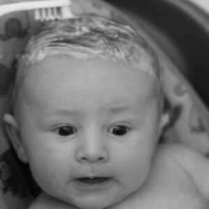 Baby is Losing Hair Due to Cradle Cap – What to Do?