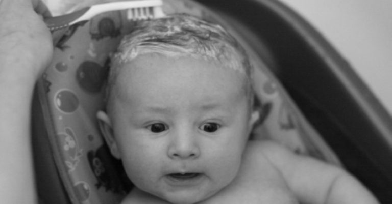 Read more about the article Baby is Losing Hair Due to Cradle Cap – What to Do?