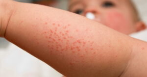 Read more about the article Red Bumps On Baby’s Face And Legs: 7 Reasons to Check