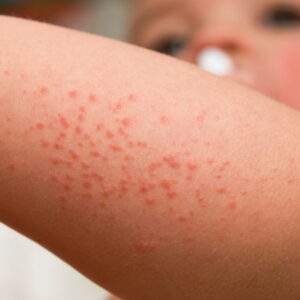Red Bumps On Baby’s Face And Legs: 7 Reasons to Check