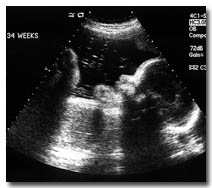 34 weeks ultrasound