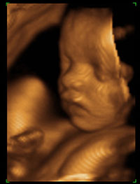32 weeks ultrasound