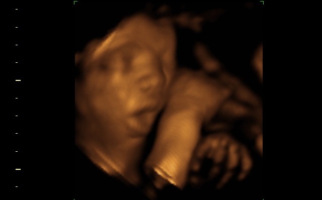 ultrasound fetus at 33 weeks pregnant
