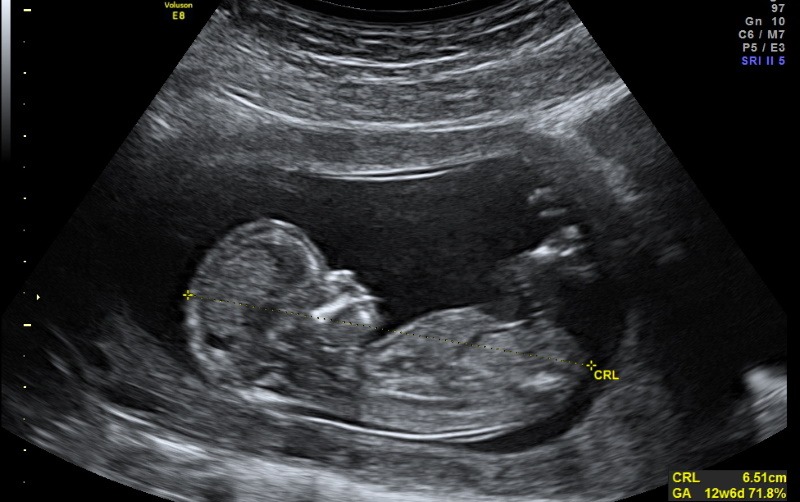 15 weeks pregnant ultrasound