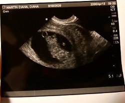 10 weeks ultrasound