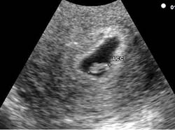 embryo at 6 weeks ultrasound