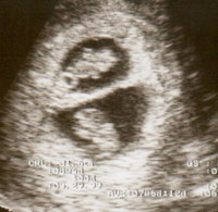Twin Pregnancy Ultrasound Scan