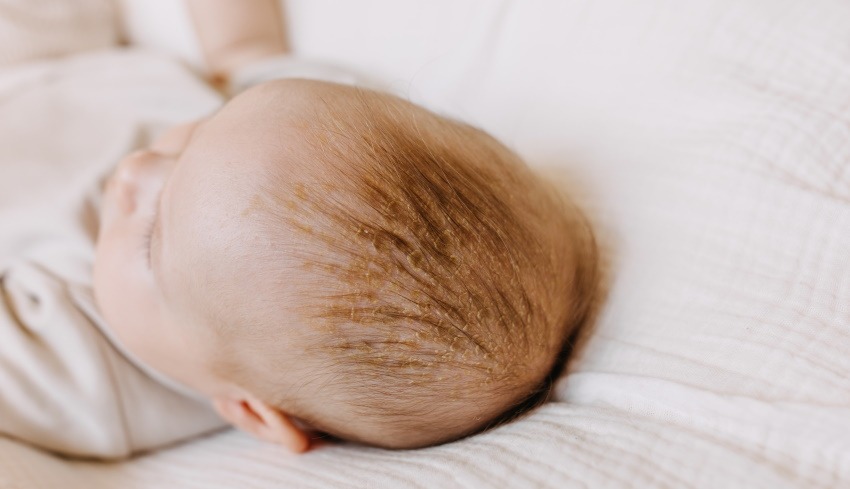 what does cradle cap look like