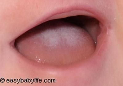 mild oral baby thrush symptoms