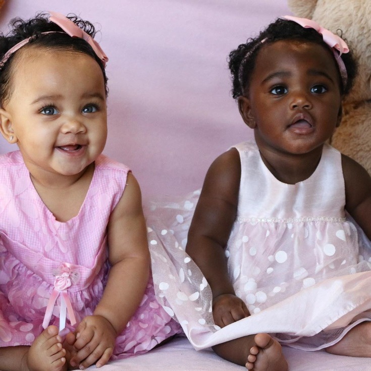 baby skin color in twins