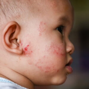 How To Get Rid Of My Baby’s Eczema? 7 Easy Tips To Try Now